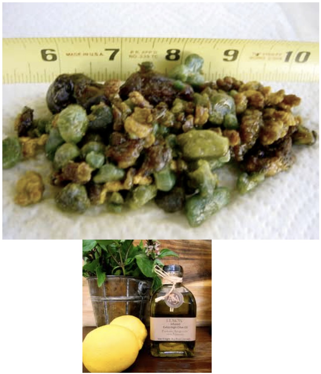 Gall Stones Photo